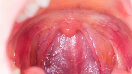 Cum poți scăpa de roșu în gât: Cauze, simptome, tratament, remedii naturiste