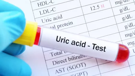 Acid uric seric: Ce boli se pot ascunde în spatele valorilor mai mari sau mici