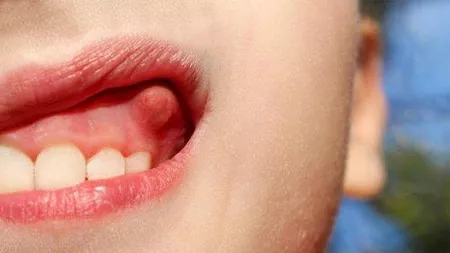Puroi la măsea: Cât de grav este și cum se tratează abcesul dentar