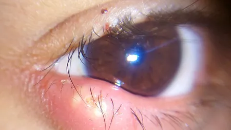 Ulcior la ochi: Tratamente care te scapă de problemă peste noapte