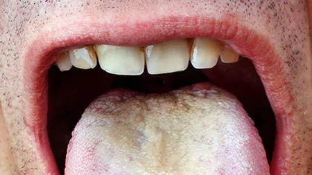Candidoza bucală: Tratament cu bicarbonat