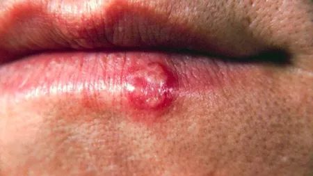 Cum scapi de herpes: Remedii naturiste care te scapă de probleme peste noapte!
