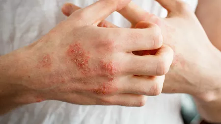 Cele mai bune leacuri bătrânești pentru eczeme: Cum să le tratezi folosind remedii naturale
