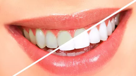 Albirea dinților acasă: Trucuri simple pentru a avea dinți mai strălucitori