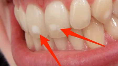 Demineralizare dinți: Cum sunt afectați micuții și ce tratamente se recomandă