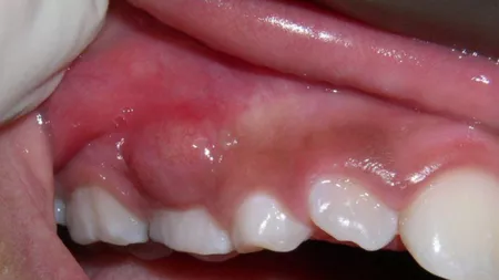 Puroi la gingie: Cum apare abcesul dentar și cum poate fi tratat rapid