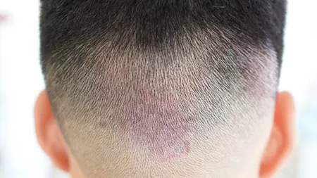 Psoriazis scalp: Simptome și tratament