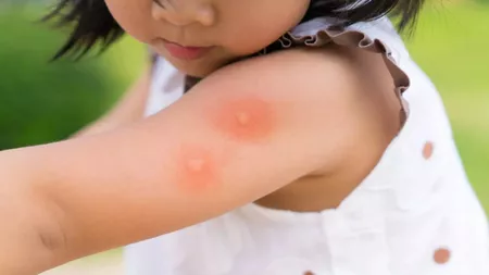 Cât de periculoase sunt mușcăturile de țânțari și cum poți sta departe de ele: Metode de prevenție și tratament