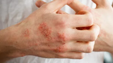 Eczema poze. Cum să identifici la timp afecțiunea