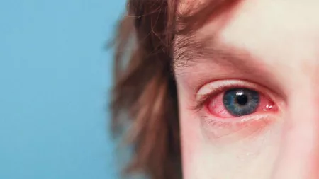 Ochii roșii la copii: Cauze și motive de îngrijorare
