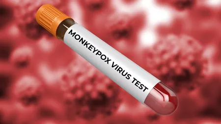 Trei noi cazuri de variola maimuței, diagnosticate în România