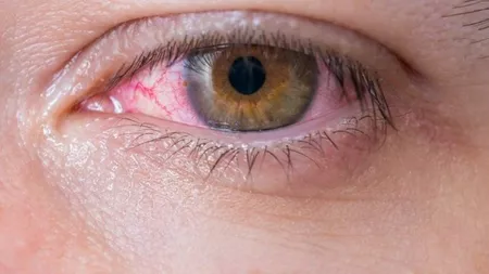 Ai vinișoare roșii pe albul ochilor? Iată care sunt cauzele acestora și cum pot fi tratate