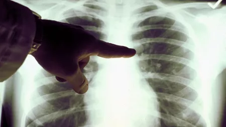 Cât trăiești cu cancer pulmonar? Află care este speranța de viață în cazul pacienților ce se confruntă cu această afecțiune