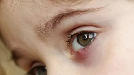 Ce simptome prezintă ulciorul la ochi și cum se tratează? Tratament rapid acasă