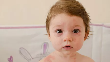 Roseola infantum poze. Cum se manifestă afecțiunea și cum poate fi tratată