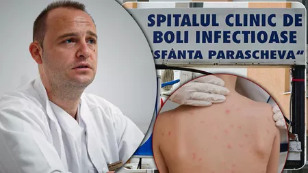 Pacient de 7 ani, internat la Spitalul Clinic de Boli Infecțioase, cu complicații determinate de varicelă! Dr. Florin Roşu: „Nu se poate spune dacă va rămâne sau nu cu sechele!”