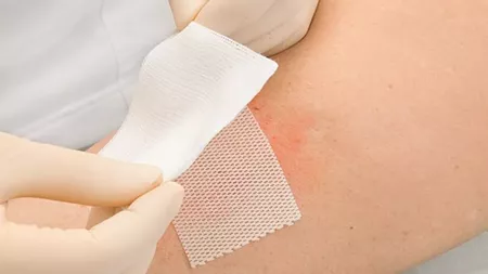 Poze cu escare. Cum pot fi tratate rapid leziunile provocate de afecțiunea dermatologică?