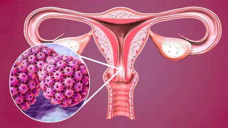 Col uterin inflamat: O afecțiune cu risc de complicații grave. Ce opțiuni de tratament există