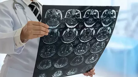 Cât trăieşte un bolnav de Alzheimer? Care sunt primele simptome ale acestei afecțiuni