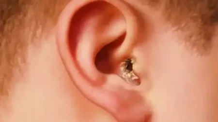 De ce se formează coji în urechi. Ce se află în spatele acestui inconvenient