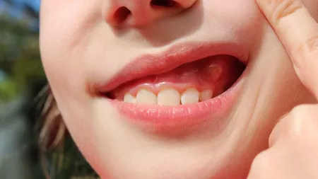 Abces dentar la copii. 3 remedii naturiste eficiente pentru ameliorarea disconfortului până la consultația medicală