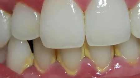 Denumirea dinților: Câți ai și cum se numesc aceștia