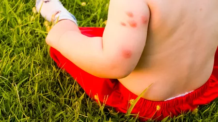 Înțepături de insecte la copii. Cum să ameliorezi inflamația de pe piele în 24 de ore?