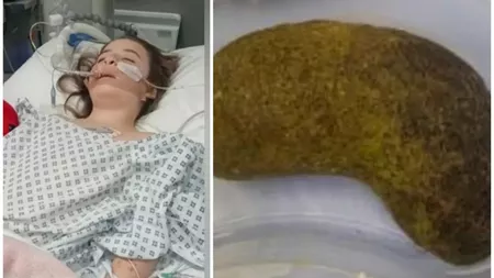 Ce au descoperit medicii în stomacul unei fetițe de 7 ani. Micuța acuza dureri abdominale severe și greață