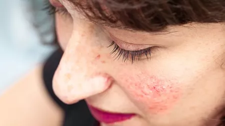 De ce apare acneea rozacee? Metode de tratament a tenului afectat