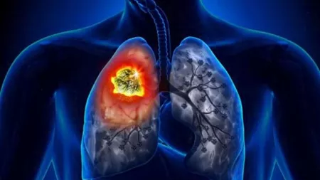 Cât se poate trăi cu metastază la plămâni? Factorii care influențează speranța de viață