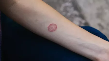 Tratament pentru pecingine la adulți. Cum se manifestă infecția fungică a pielii