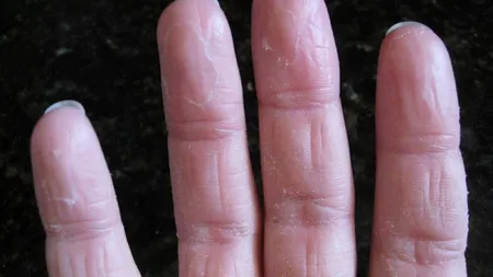Cum elimini pielea decojita de pe buricele degetelor