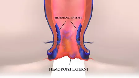 Reteta pentru oprirea sangerarii hemoroizilor