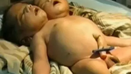 Bebelus cu doua capete nascut în India - VIDEO