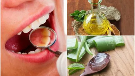 6 remedii naturale pentru indepartarea tartrului dentar