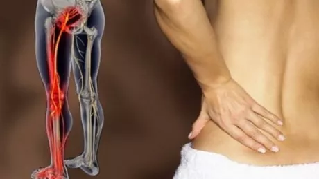 Spuneti la revedere durerii de sciatica Imbunatatiri in doar 10 minute cu aceasta metoda naturala