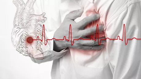 Care este diferenta dintre infarct si stop cardiac. Multi le confunda