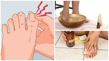 Trateaza unghiile incarnate cu 6 remedii naturale