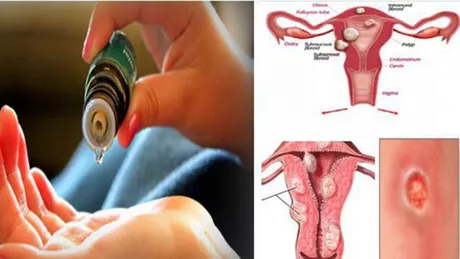 Fibrom uterin - Remedii despre care spune ca te scapa de fibrom fara operatie