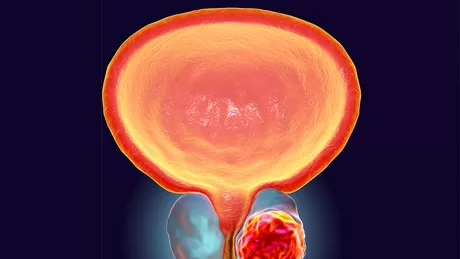 Consumul de ciuperci reduce riscul de cancer de prostată
