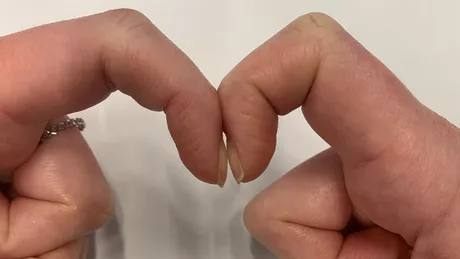 Acest simplu gest al degetelor face cu adevărat posibilă detectarea cancerului pulmonar