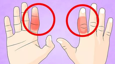 Cum tratezi un deget rupt și cum recunoști o astfel de fractură