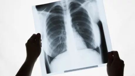 Plămânii au puterea magică de a vindeca daunele provocate de fumat cu o condiție