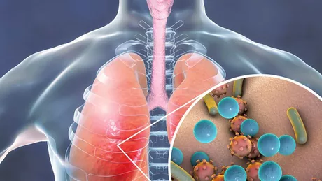 Vitamina care ne fereşte de pneumonie. Poate preveni sau trata o răceală