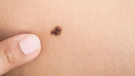 De ce barbatii au un risc genetic mai mare de a face melanom