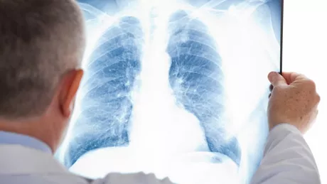 Ce trebuie sa stii despre tuberculoza
