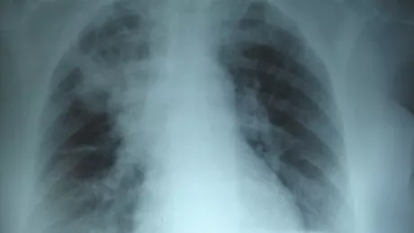 Oamenii de știință au aflat motivul pentru care bolnavii de fibroză chistică suferă de atât de multe infecții respiratorii