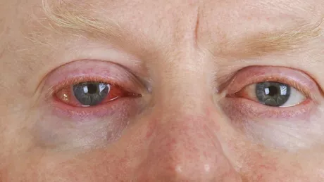 Ce este herpesul ocular