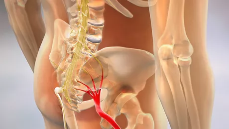 Sciatica 7 sfaturi de la un reumatolog