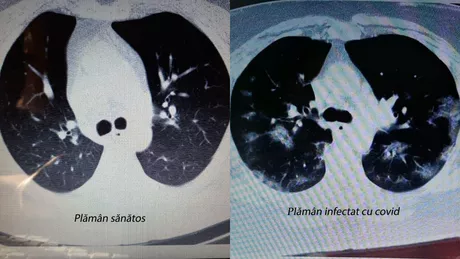 Situație inexplicabilă Medicul radiolog care analizează plămânii bolnavilor infectați cu COVID-19 răstoarnă tot ceea ce s-a știut până acum Imagini identice dar diagnosticul diferit